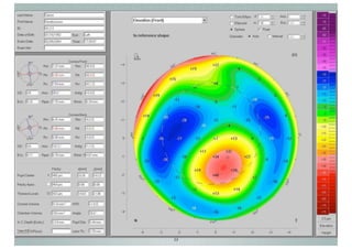 Topographie cornéenne
Topographie d'élévation : modes

J-A.DOUAUD - ISO Bordeaux - 2013/2014

23

 