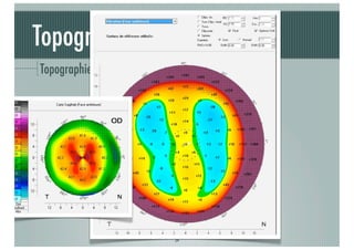 Topographie cornéenne
Topographie d'élévation : modes

J-A.DOUAUD - ISO Bordeaux - 2013/2014

24

 