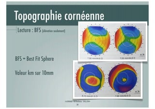 Topographie cornéenne
Lecture : BFS (élévation seulement)

BFS = Best Fit Sphere
Valeur km sur 10mm

J-A.DOUAUD - ISO Bordeaux - 2013/2014

34

 