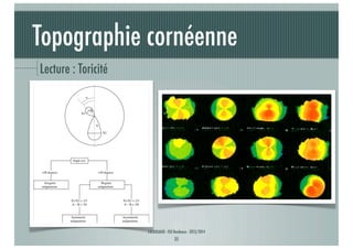 Topographie cornéenne
Lecture : Toricité

J-A.DOUAUD - ISO Bordeaux - 2013/2014

35

 