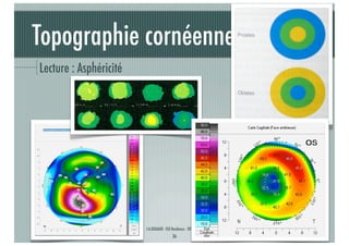Topographie cornéenne
Lecture : Asphéricité

J-A.DOUAUD - ISO Bordeaux - 2013/2014

36

 