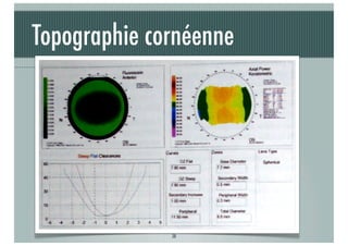 Topographie cornéenne
Aide à l’adaptation

J-A.DOUAUD - ISO Bordeaux - 2013/2014

38

 