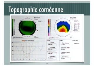 Topographie cornéenne
Aide à l’adaptation

J-A.DOUAUD - ISO Bordeaux - 2013/2014

39

 