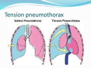 Tension pneumothorax
 