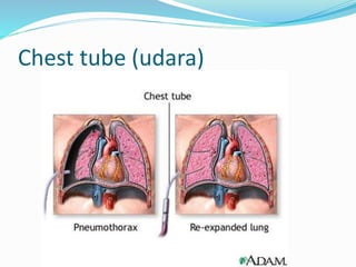 Chest tube (udara)
 