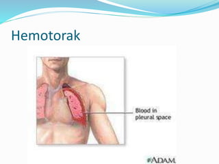 Hemotorak
 