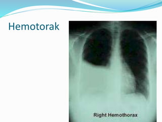Hemotorak
 