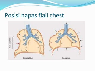 Posisi napas flail chest
 