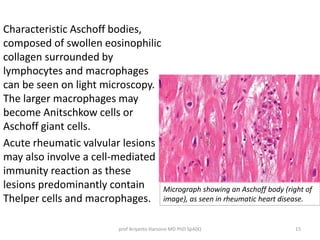 Characteristic Aschoff bodies, 
composed of swollen eosinophilic 
collagen surrounded by 
lymphocytes and macrophages 
can be seen on light microscopy. 
The larger macrophages may 
become Anitschkow cells or 
Aschoff giant cells. 
Acute rheumatic valvular lesions 
may also involve a cell-mediated 
immunity reaction as these 
lesions predominantly contain 
Thelper cells and macrophages. 
Micrograph showing an Aschoff body (right of 
image), as seen in rheumatic heart disease. 
prof Ariyanto Harsono MD PhD SpA(K) 15 
 