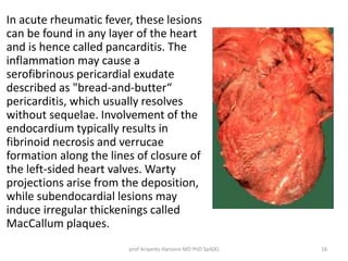 In acute rheumatic fever, these lesions 
can be found in any layer of the heart 
and is hence called pancarditis. The 
inflammation may cause a 
serofibrinous pericardial exudate 
described as "bread-and-butter“ 
pericarditis, which usually resolves 
without sequelae. Involvement of the 
endocardium typically results in 
fibrinoid necrosis and verrucae 
formation along the lines of closure of 
the left-sided heart valves. Warty 
projections arise from the deposition, 
while subendocardial lesions may 
induce irregular thickenings called 
MacCallum plaques. 
prof Ariyanto Harsono MD PhD SpA(K) 16 
 