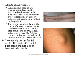  Subcutaneous nodules 
 Subcutaneous nodules are 
uncommon and are usually 
associated with severe carditis. 
They tend to occur several weeks 
after illness onset, are usually 
painless, and usually go unnoticed 
by the patient. 
 They are found primarily over the 
bony surfaces or prominences and 
in tendon sheaths. The common 
sites include the elbows, knees, 
wrists, ankles, over the Achilles 
tendon, the back of the scalp, and 
spinous process of the vertebrae.[2] 
 They usually persist for 1-2 
weeks. The main differential 
diagnosis is the nodules of 
rheumatoid arthritis. 
Prof Ariyanto Harsono MD PhD SpA(K) 27 
 