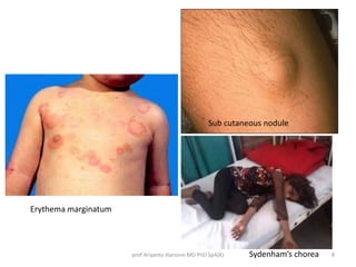 prof Ariyanto Harsono MD PhD SpA(K) 8 
Erythema marginatum 
Sub cutaneous nodule 
Sydenham’s chorea 
 