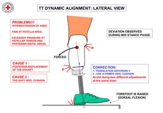 8
PROBLEMS!!!
HYPEREXTENSION OF KNEE.
PAIN AT PATELLA AREA.
EXCESSIVE PRESSURE AT
PATELLAR TENDON AND
POSTERIOR DISTAL AREAS.
CAUSE 1 :
POSTERIOR DISPLACEMENT
OF THE SOCKET.
CORRECTION:
1- TRANSLATION ANTERIORLY
2 - USE A FIRMER HEEL CUSHION
Avoid doing two different adjustments
at the same time!
FORCES
P
P
1
TT DYNAMIC ALIGNMENT: LATERAL VIEW
CAUSE 2 :
TOO SOFT HEEL CUSHION.
DEVIATION OBSERVED
DURING MID STANCE PHASE.
FOREFOOT IS RAISED
(DORSAL FLEXION)
 