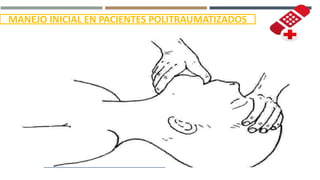 MANEJO INICIAL EN PACIENTES POLITRAUMATIZADOS
MANIOBRA DE ELEVACIÓN
MANDIBULAR
 