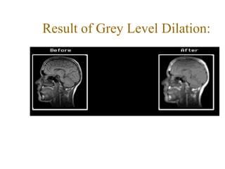 Result of Grey Level Dilation:
 