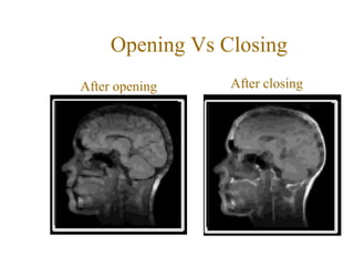 Opening Vs Closing
After opening After closing
 
