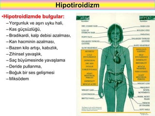 59
Hipotiroidizm
•Hipotroidizmde bulgular:
–Yorgunluk ve aşırı uyku hali,
–Kas güçsüzlüğü,
–Bradikardi, kalp debisi azalması,
–Kan hacminin azalması,
–Bazen kilo artışı, kabızlık,
–Zihinsel yavaşlık,
–Saç büyümesinde yavaşlama
–Deride pullanma,
–Boğuk bir ses gelişmesi
– Miksödem
 