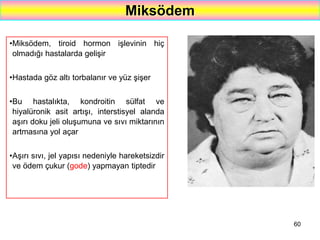60
Miksödem
•Miksödem, tiroid hormon işlevinin hiç
olmadığı hastalarda gelişir
•Hastada göz altı torbalanır ve yüz şişer
•Bu hastalıkta, kondroitin sülfat ve
hiyalüronik asit artışı, interstisyel alanda
aşırı doku jeli oluşumuna ve sıvı miktarının
artmasına yol açar
•Aşırı sıvı, jel yapısı nedeniyle hareketsizdir
ve ödem çukur (gode) yapmayan tiptedir
 