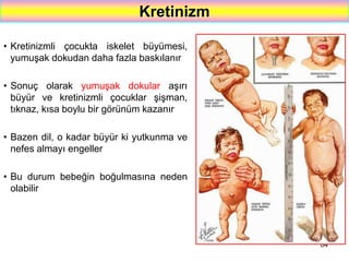 64
Kretinizm
• Kretinizmli çocukta iskelet büyümesi,
yumuşak dokudan daha fazla baskılanır
• Sonuç olarak yumuşak dokular aşırı
büyür ve kretinizmli çocuklar şişman,
tıknaz, kısa boylu bir görünüm kazanır
• Bazen dil, o kadar büyür ki yutkunma ve
nefes almayı engeller
• Bu durum bebeğin boğulmasına neden
olabilir
 