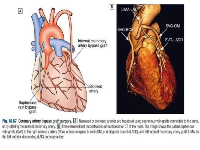 Free Free Svg Heart Artery 203 SVG PNG EPS DXF File