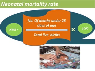 Neonatal mortality rate
NMR = 1000
No. Of deaths under 28
days of age
Total live births
 
