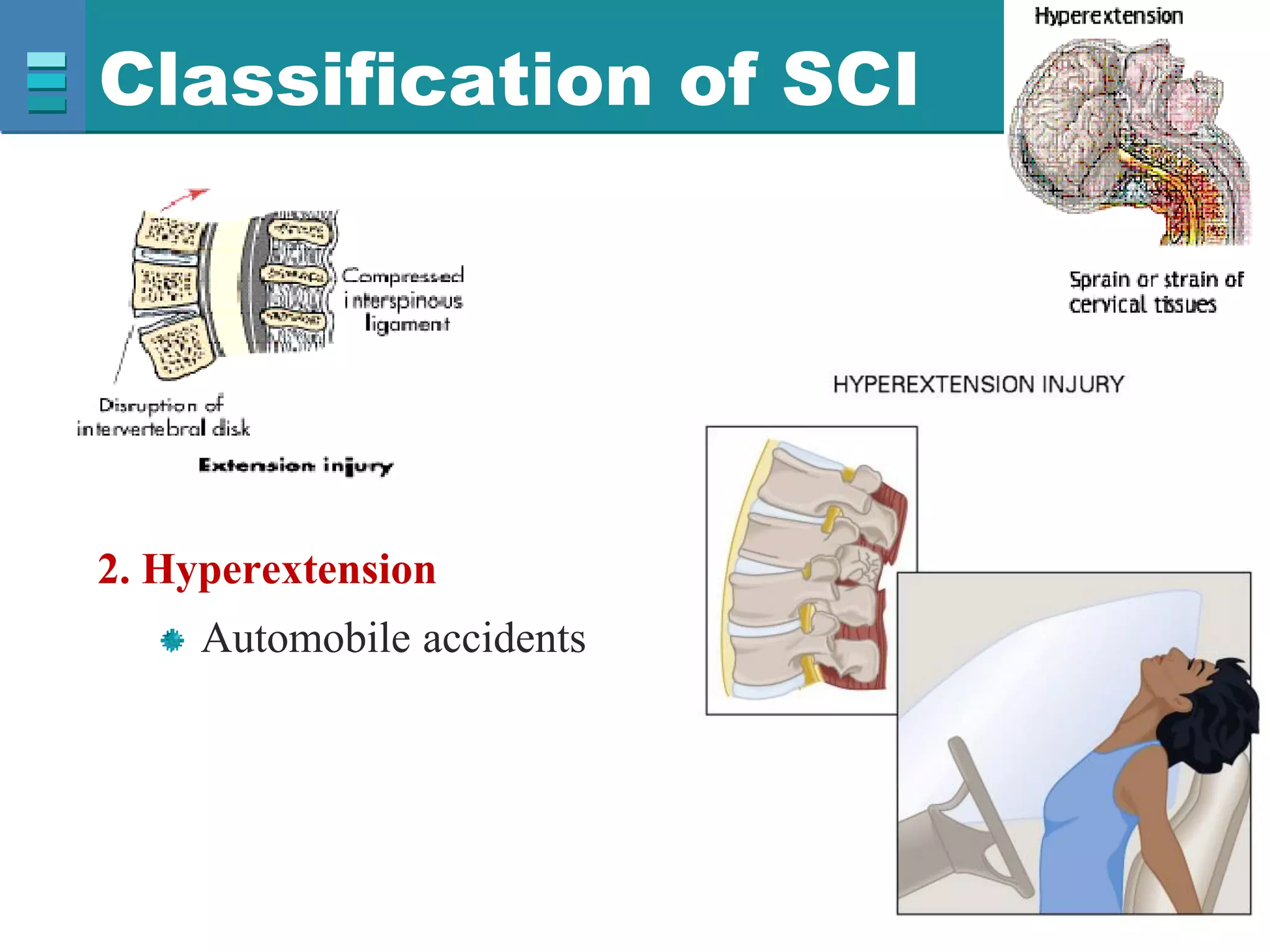Classification of SCI
2. Hyperextension
Automobile accidents
 