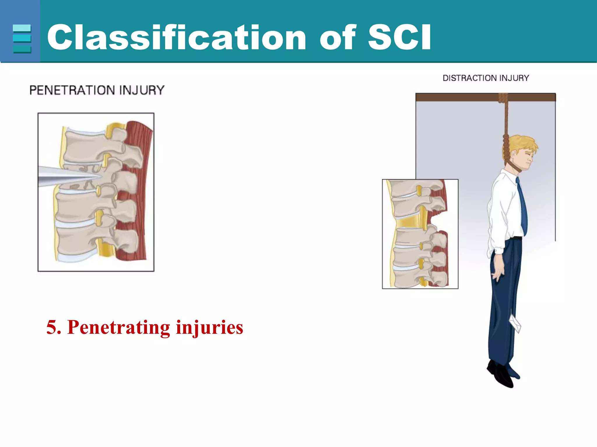 Classification of SCI
5. Penetrating injuries
 
