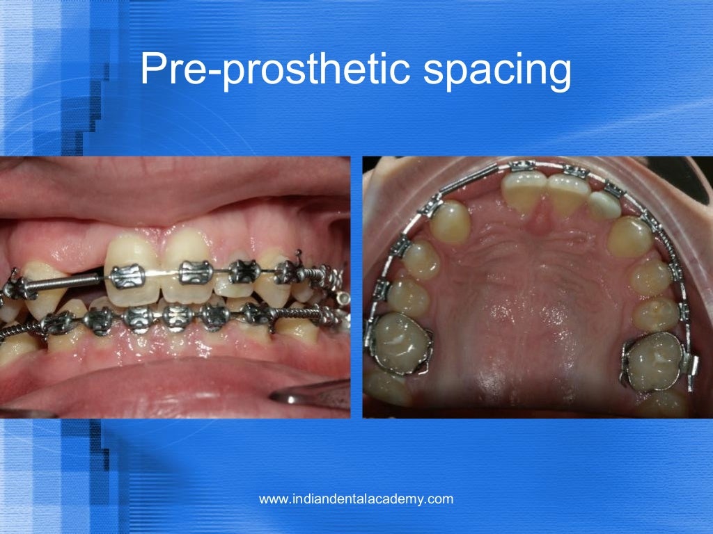 orthodontic finishing and retention