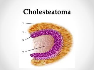 Cholesteatoma
 
