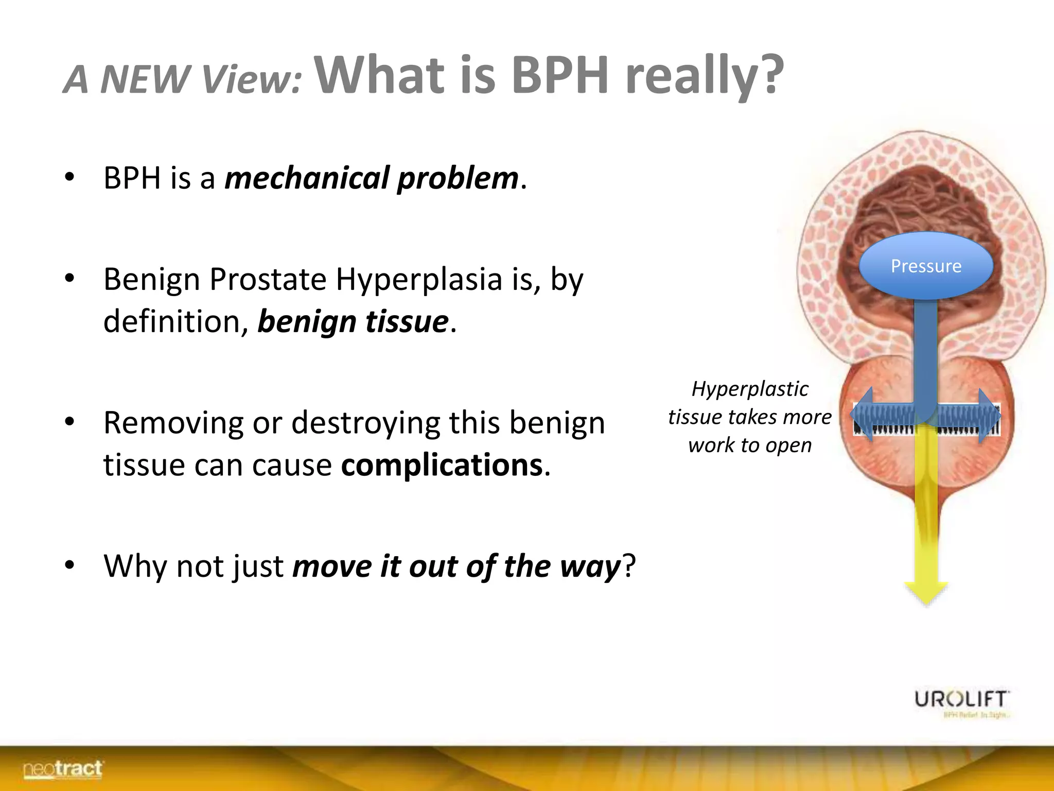 A NEW View: What is BPH really?
• BPH is a mechanical problem.
• Benign Prostate Hyperplasia is, by
definition, benign tissue.
• Removing or destroying this benign
tissue can cause complications.
• Why not just move it out of the way?
Pressure
Hyperplastic
tissue takes more
work to open
 