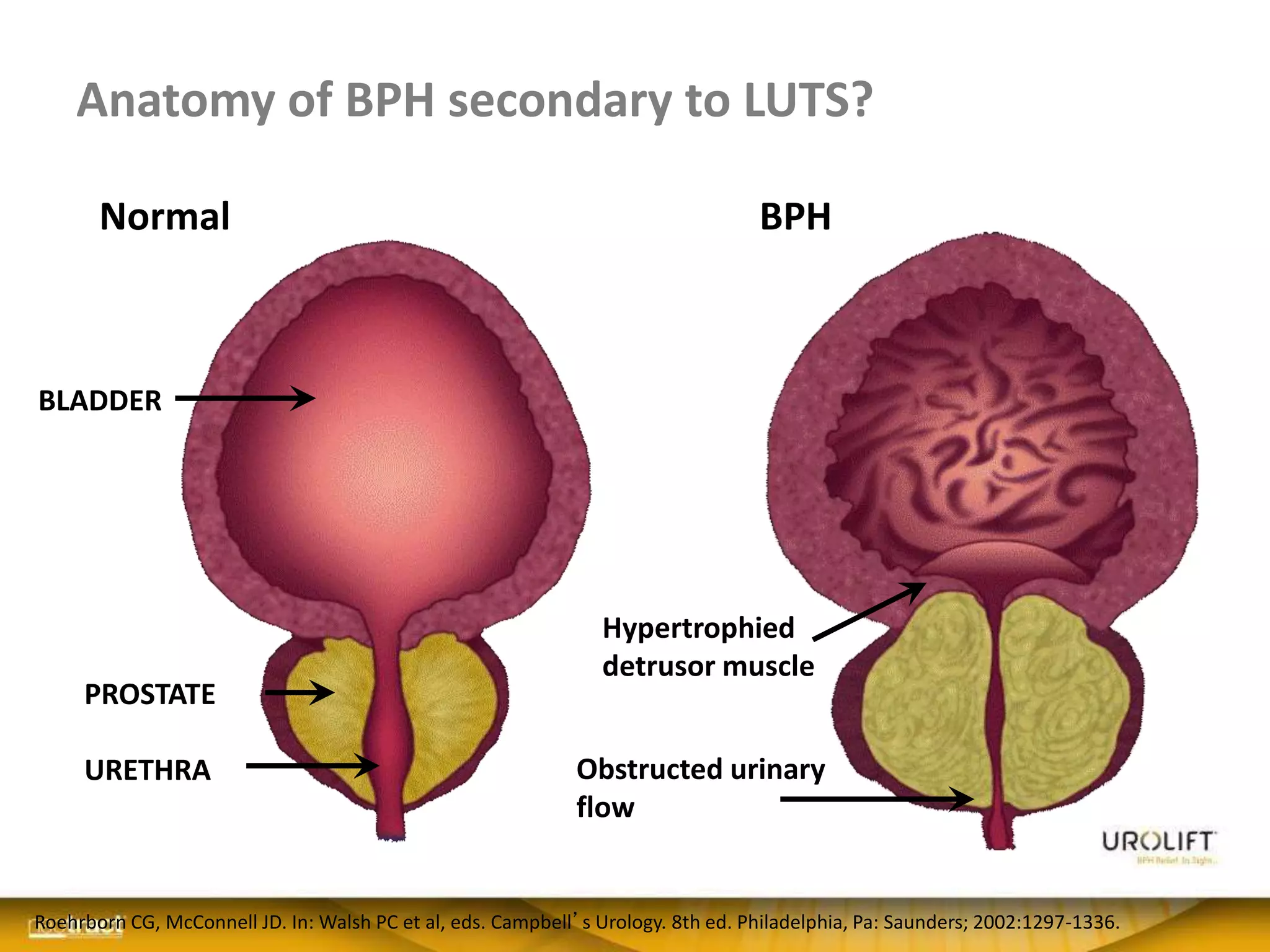 Anatomy of BPH secondary to LUTS?
Normal BPH
Hypertrophied
detrusor muscle
Obstructed urinary
flow
PROSTATE
BLADDER
URETHRA
Roehrborn CG, McConnell JD. In: Walsh PC et al, eds. Campbell’s Urology. 8th ed. Philadelphia, Pa: Saunders; 2002:1297-1336.
 