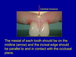The mesial of each tooth should be on the
midline (arrow) and the incisal edge should
be parallel to and in contact with the occlusal
plane.
Central incisors
 