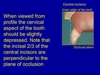 When viewed from
profile the cervical
aspect of the tooth
should be slightly
depressed. Note that
the incisal 2/3 of the
central incisors are
perpendicular to the
plane of occlusion
Inner edge of the land
Occlusal plane
Central incisors
 