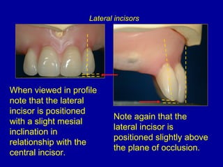 When viewed in profile
note that the lateral
incisor is positioned
with a slight mesial
inclination in
relationship with the
central incisor.
Note again that the
lateral incisor is
positioned slightly above
the plane of occlusion.
Lateral incisors
 