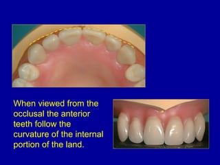 When viewed from the
occlusal the anterior
teeth follow the
curvature of the internal
portion of the land.
 