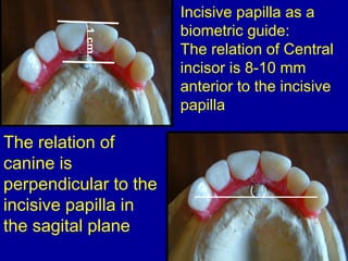 Incisive papilla as a
biometric guide:
The relation of Central
incisor is 8-10 mm
anterior to the incisive
papilla
The relation of
canine is
perpendicular to the
incisive papilla in
the sagital plane
 