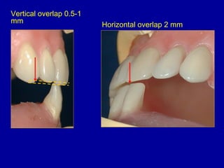 Vertical overlap 0.5-1
mm
Horizontal overlap 2 mm
 