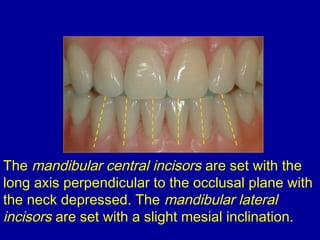 The mandibular central incisors are set with the
long axis perpendicular to the occlusal plane with
the neck depressed. The mandibular lateral
incisors are set with a slight mesial inclination.
 