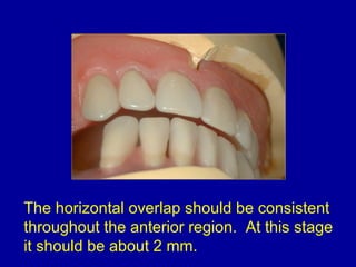 The horizontal overlap should be consistent
throughout the anterior region. At this stage
it should be about 2 mm.
 
