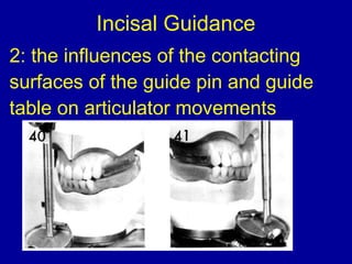 Incisal Guidance
2: the influences of the contacting
surfaces of the guide pin and guide
table on articulator movements
 