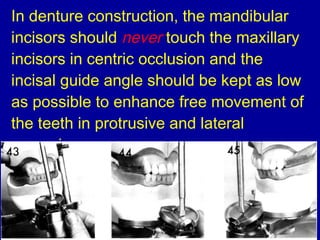 In denture construction, the mandibular
incisors should never touch the maxillary
incisors in centric occlusion and the
incisal guide angle should be kept as low
as possible to enhance free movement of
the teeth in protrusive and lateral
excursions.
 