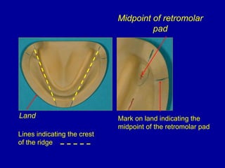 Lines indicating the crest
of the ridge
Midpoint of retromolar
pad
Mark on land indicating the
midpoint of the retromolar pad
Land
 