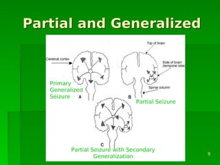 Partial and GeneralizedPartial and Generalized
Partial Seizure with Secondary
Generalization
Primary
Generalized
Seizure
Partial Seizure
99
 