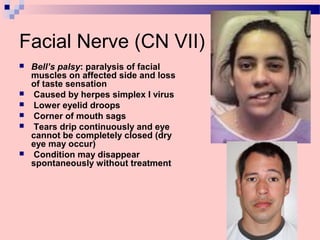Facial Nerve (CN VII)
 Bell’s palsy: paralysis of facial
muscles on affected side and loss
of taste sensation
 Caused by herpes simplex I virus
 Lower eyelid droops
 Corner of mouth sags
 Tears drip continuously and eye
cannot be completely closed (dry
eye may occur)
 Condition may disappear
spontaneously without treatment
 