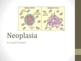 Neoplasia
Dr. Saugat Chapagain
 