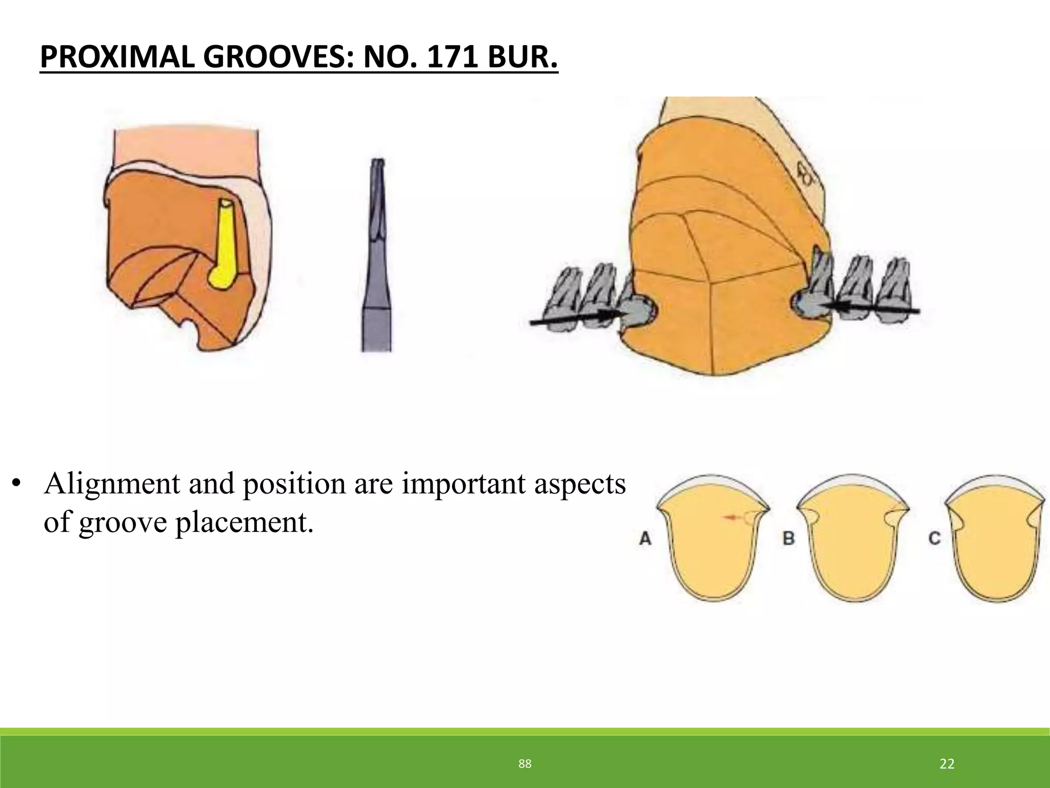 posterior partial veneer crowns - Kelly | PPTX