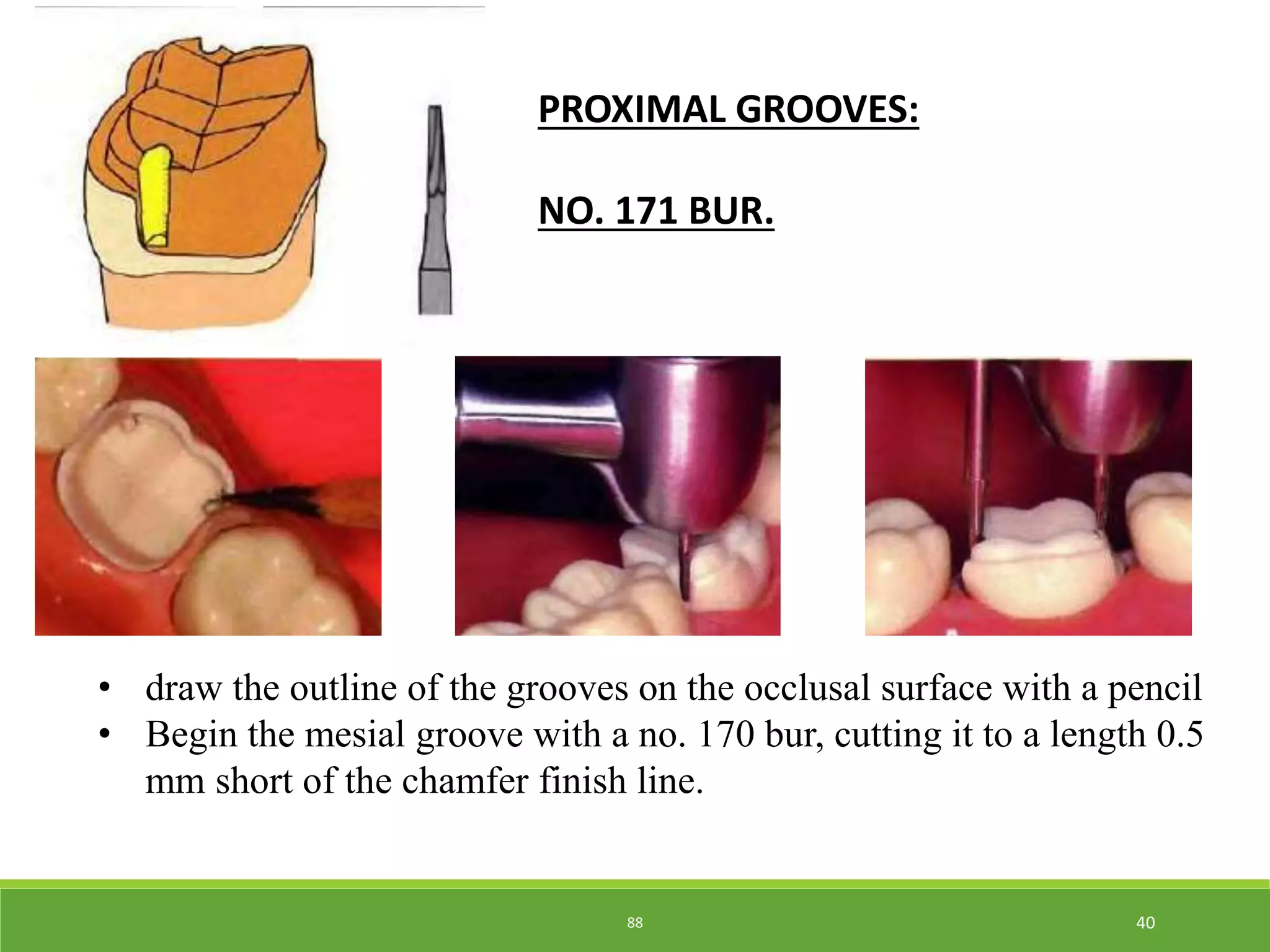 posterior partial veneer crowns - Kelly | PPTX