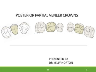 POSTERIOR PARTIAL VENEER CROWNS
88
PRESENTED BY
DR.KELLY NORTON
1
 