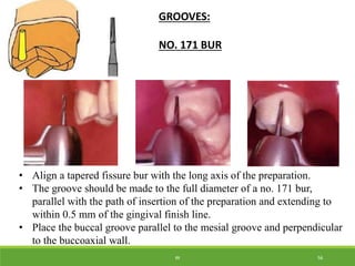 posterior partial veneer crowns - Kelly | PPTX