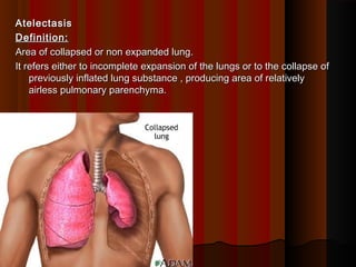 AtelectasisAtelectasis
Definition:Definition:
Area of collapsed or non expanded lung.Area of collapsed or non expanded lung.
It refers either to incomplete expansion of the lungs or to the collapse ofIt refers either to incomplete expansion of the lungs or to the collapse of
previously inflated lung substance , producing area of relativelypreviously inflated lung substance , producing area of relatively
airless pulmonary parenchyma.airless pulmonary parenchyma.
 